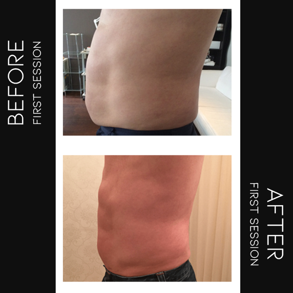 b12 injections aberdeen Subcutaneous Injection: What It Is and How to Give One