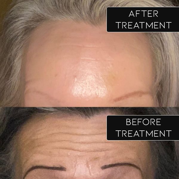 before and after botox